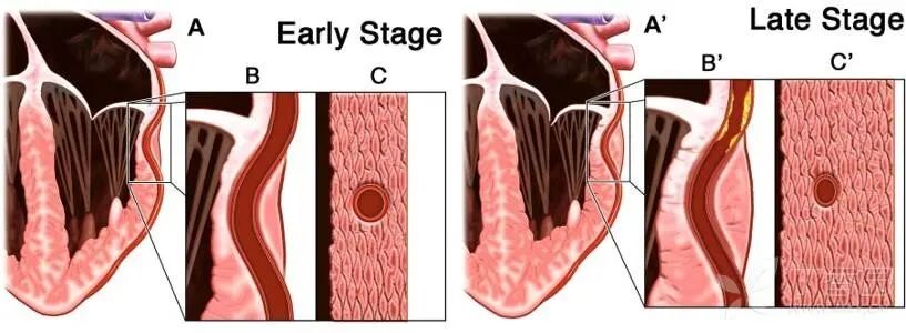 发现浅表性心肌桥多久复查,心肌桥最新发现