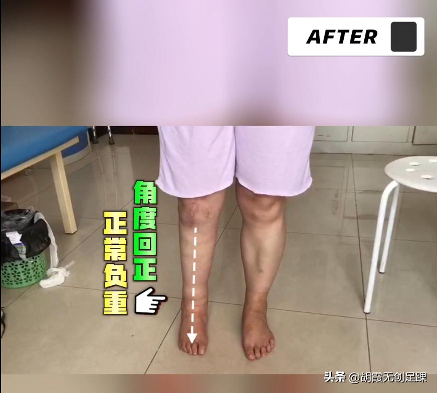 马蹄内翻足矫正后遗症,30岁严重的马蹄内翻足矫正