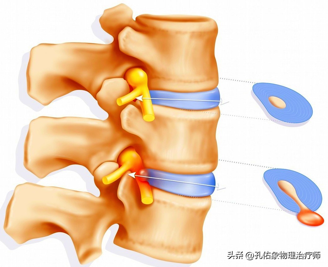 早上起床腰痛运动后缓解是什么病,腰痛怎么睡可以缓解疼痛