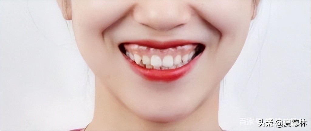 笑起来露牙龈的很难看怎么改善,笑起来不好看露牙龈怎么办
