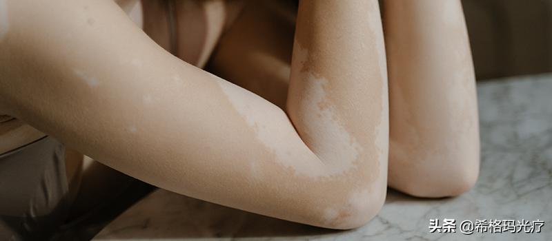 一针就能“解决”银屑病，真的这么神奇吗？