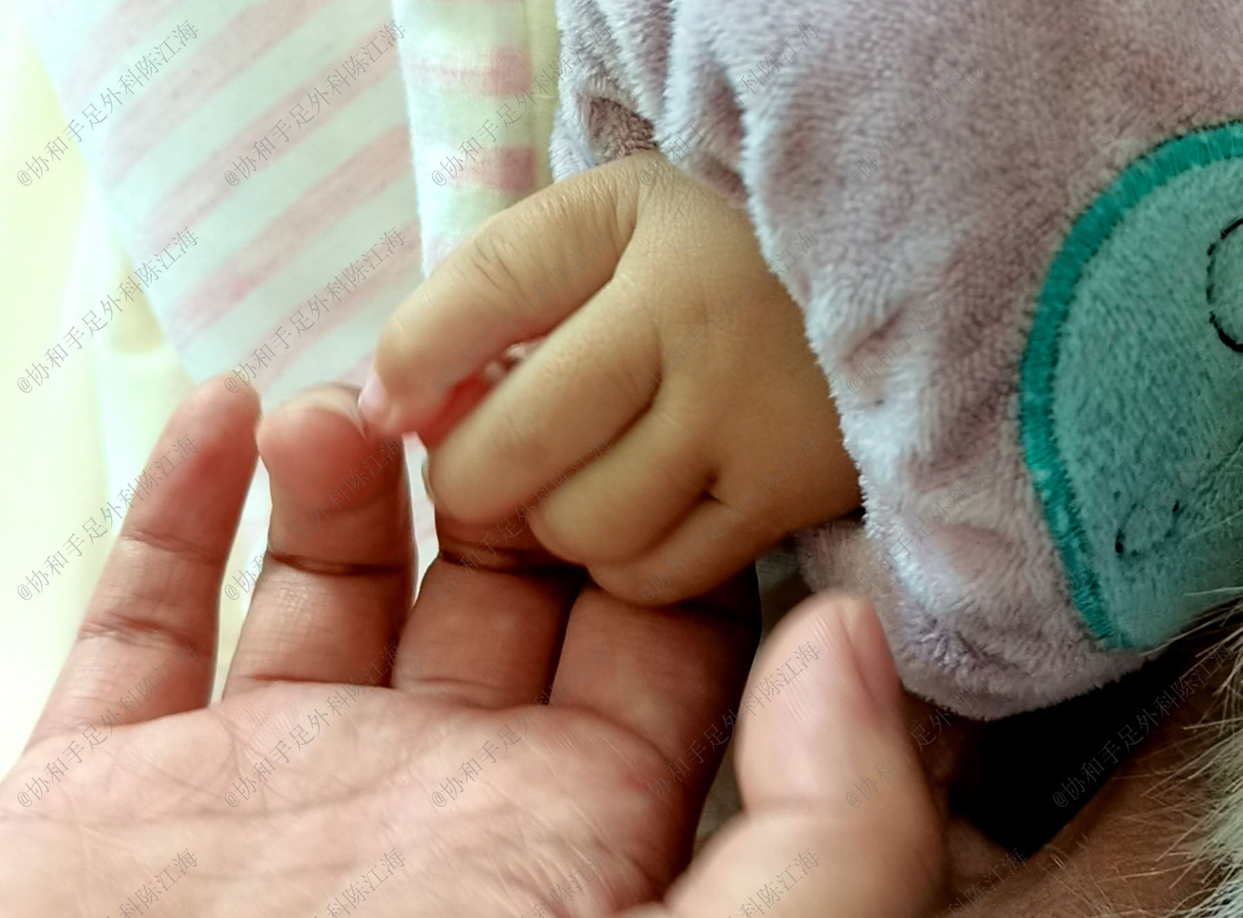 宝宝漂浮拇，被建议“一刀切”做示指拇化，我该怎么办？