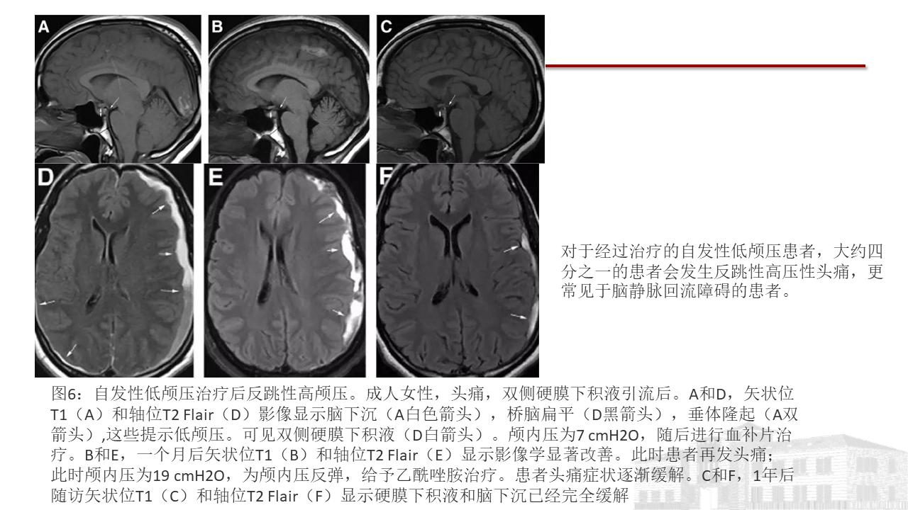 低颅压综合征耳闷,低颅压综合征吃什么药