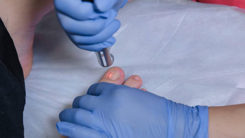 治疗灰指甲用什么中草药能根除,治疗灰指甲需要注意什么