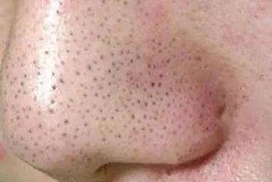 脸颊有黑头粉刺毛孔堵塞怎么办,脸上很多黑头粉刺怎么解决