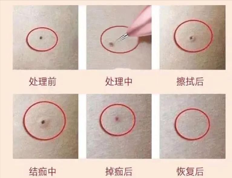 可以一个人取痣吗,点痣如何不翻车