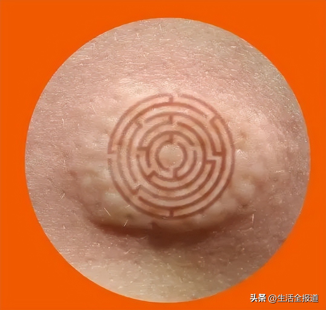 蚊子包止痒妙招,怎么给蚊子包止痒