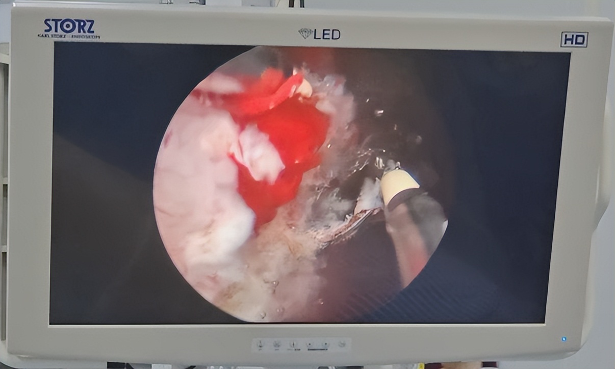 膀胱癌的诊断与鉴别诊断,膀胱癌的诊断与治疗