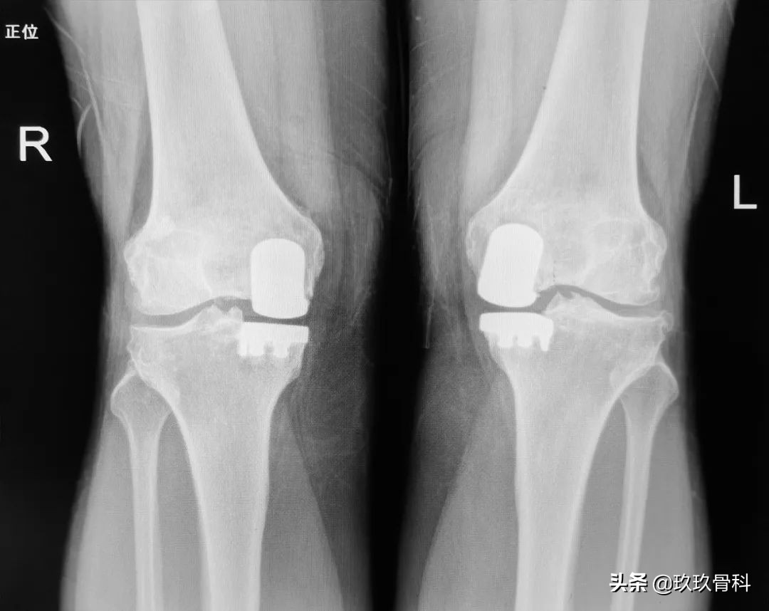 贵阳东方骨科医院膝关节置换,骨科单髁置换手术