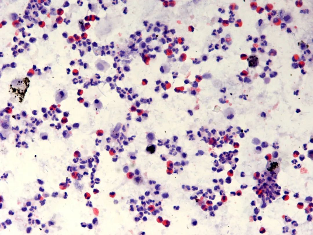 当哮喘患者咳出果冻样、啫喱样，甚至是长条形痰栓，究竟怎么了？
