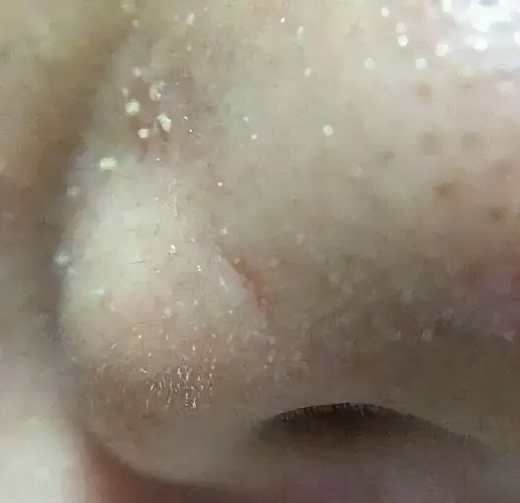 清洁面膜可以去黑头粉刺闭口吗,清洁面膜可以去除黑头吗