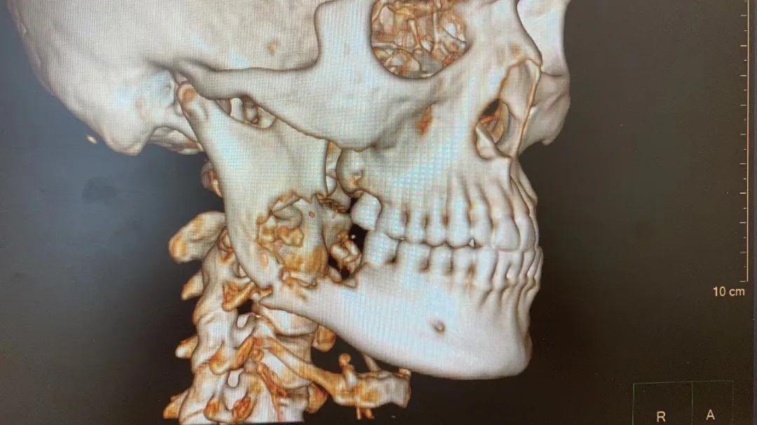 46岁男子确诊癌症,男子牙疼是癌