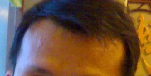 男士植发过来人真实感受,16000字讲述植发真实感受