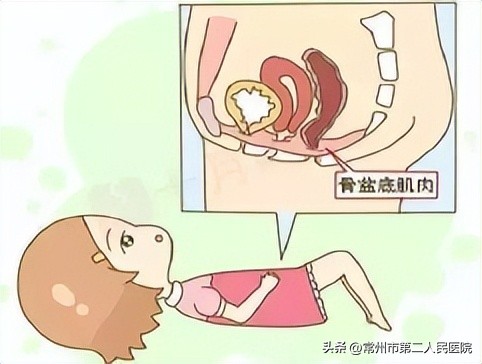 盆底康复呵护女性,如何预防盆底肌疾病