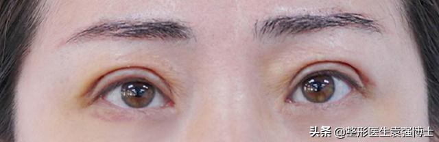 眼周年轻化手术效果可以持续多久,眼周医美项目