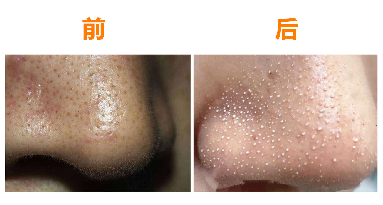 美容院护肤去黑头正常价格,小气泡去黑头美容仪器