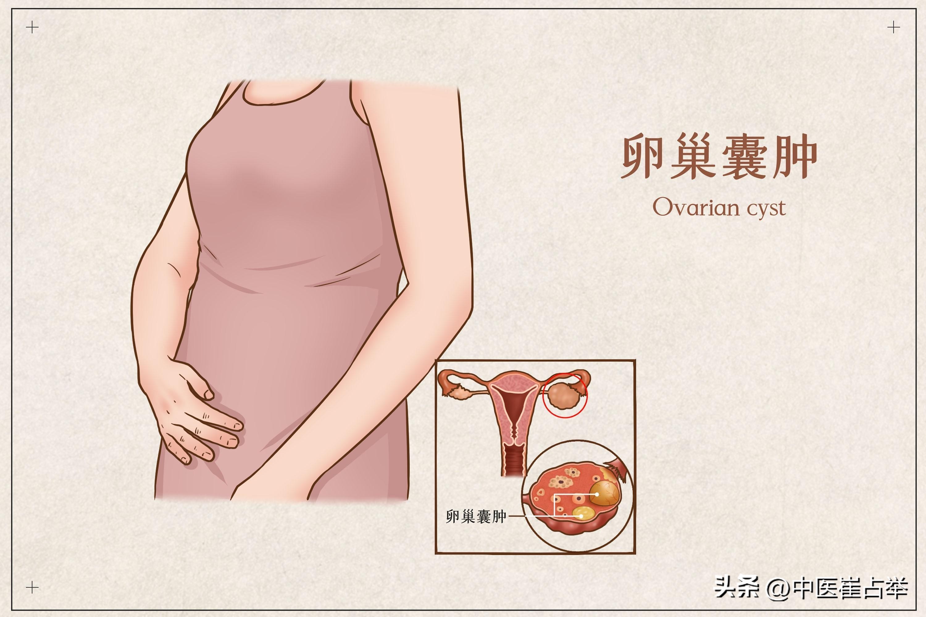 妇科圣药桂枝茯苓丸，除了活血化瘀，用好了还能治这6种病