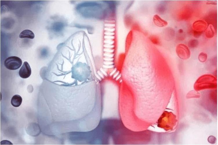 肺癌抗癌7年的真实经历,肺癌晚期10年抗癌成功案例