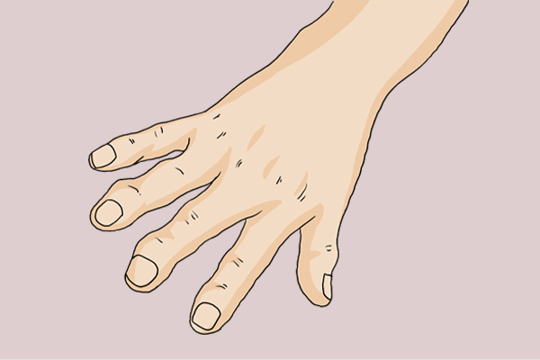 早起手指发胀握不住咋回事,早起手指发胀不能握紧是怎么回事