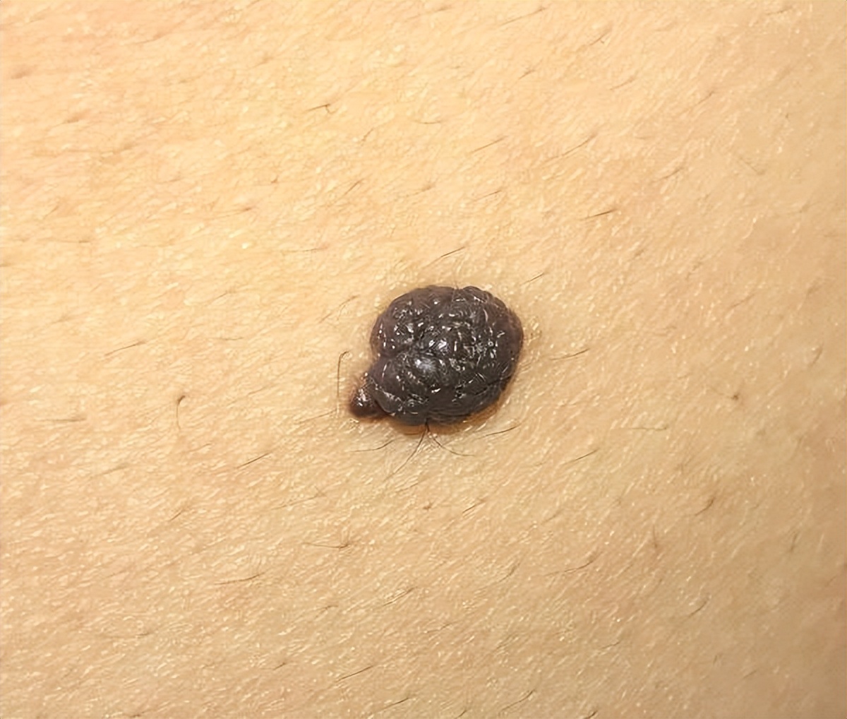 黑痣长在脸上各部位代表什么图片,医生说黑痣有癌变的可能怎么办