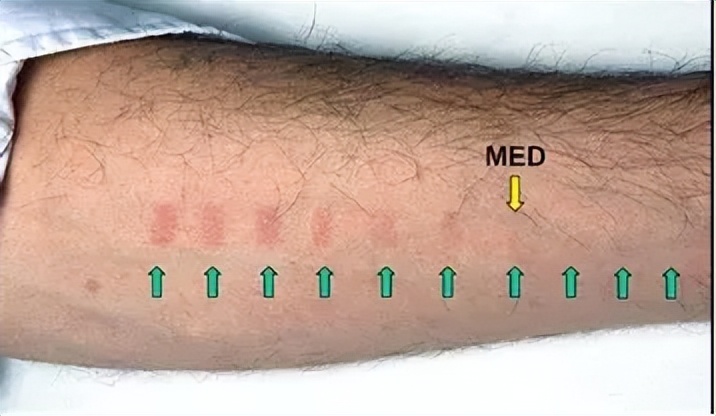 白癜风照光后起水泡破皮怎么办,照光后白癜风越来越多