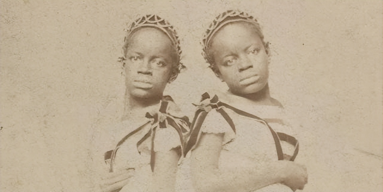 连体双胞胎姐妹的悲惨人生,双胞胎姐妹一个死亡后续