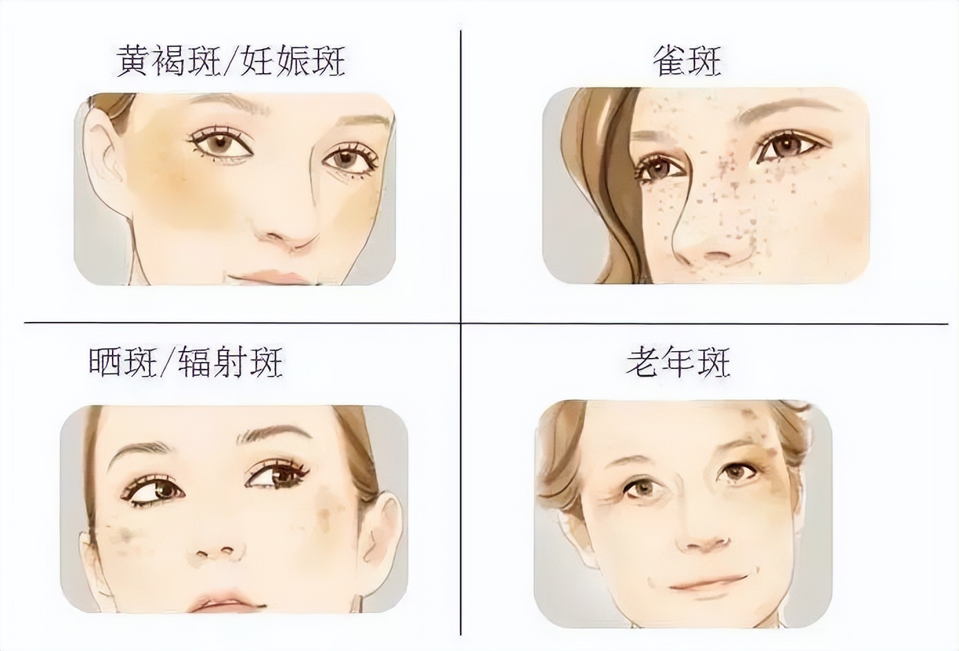 祛斑的机器与方法都有哪些,祛斑的专用穴位