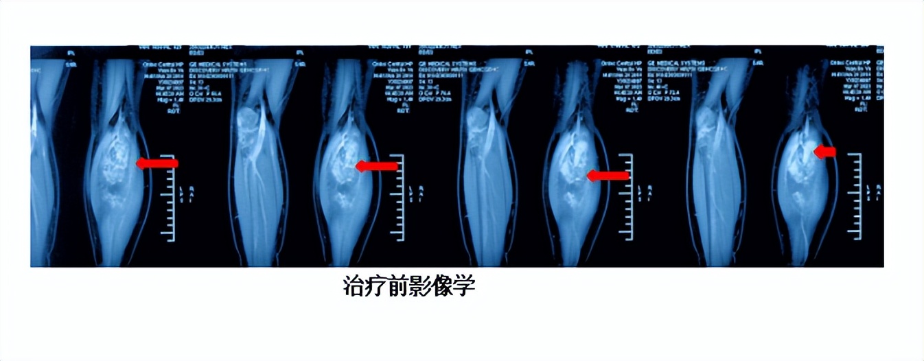 下肢血管畸形介入,小腿血管畸形介入治疗注意什么