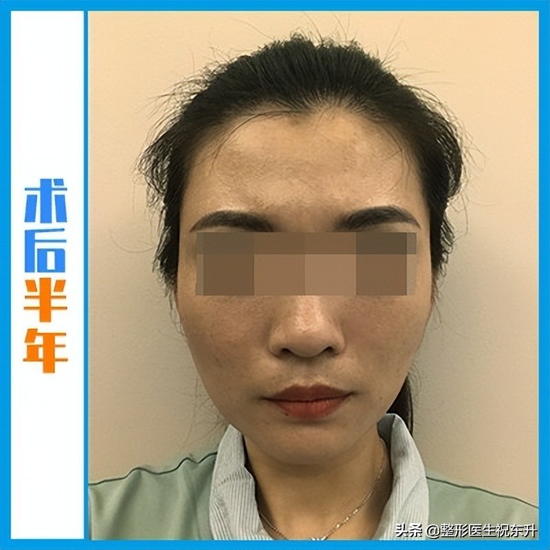 拉皮手术面诊,华西拉皮手术面诊后多长时间手术