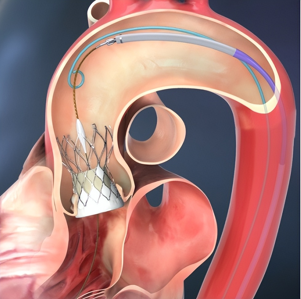 河南大学淮河医院顺利为一例二叶式主动脉瓣重度狭窄伴重度钙化的病人实施了经导管主动脉瓣置换术