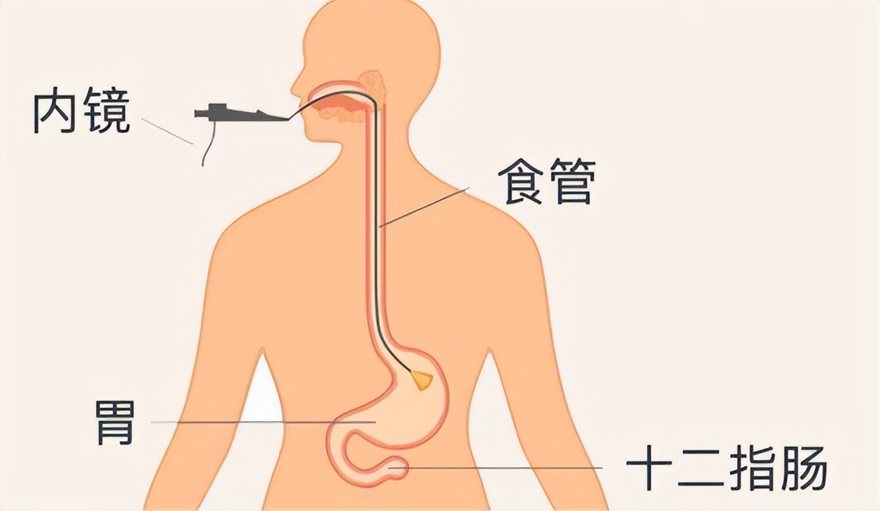 做完胃镜怎么看报告,做完胃镜怎么看胃有没有问题
