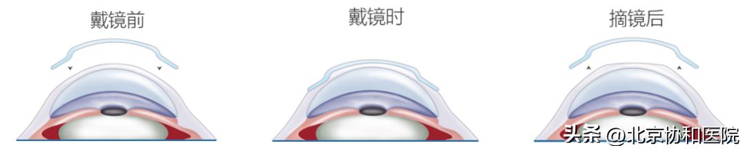 ok镜是怎么控制近视的,ok镜真的能治好初期近视吗