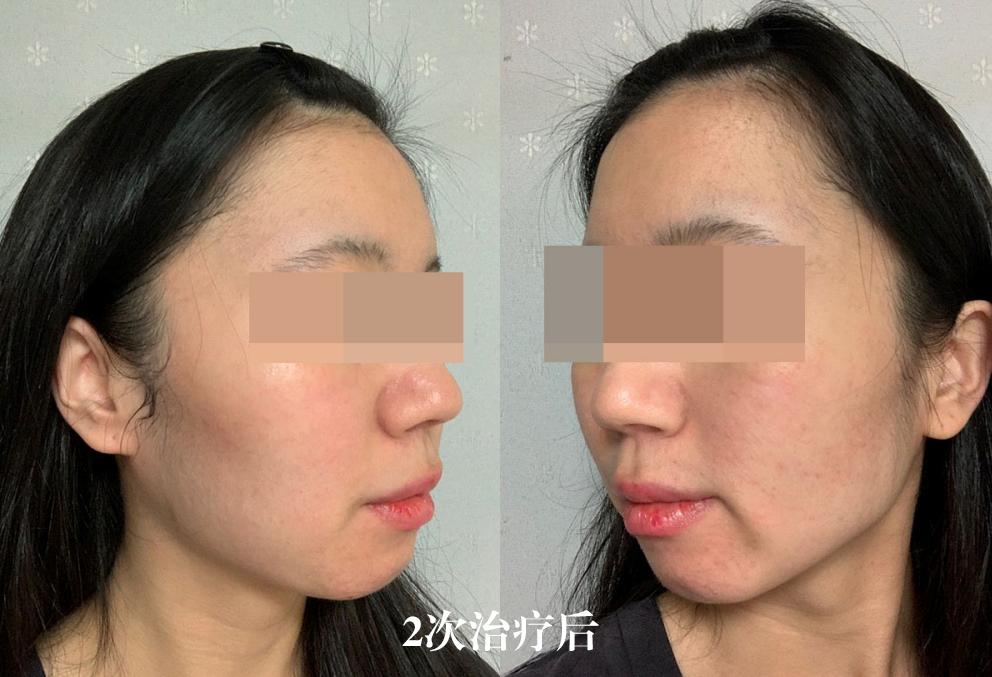 五年的痘坑能用生长因子吗,五年的痘印怎么祛除