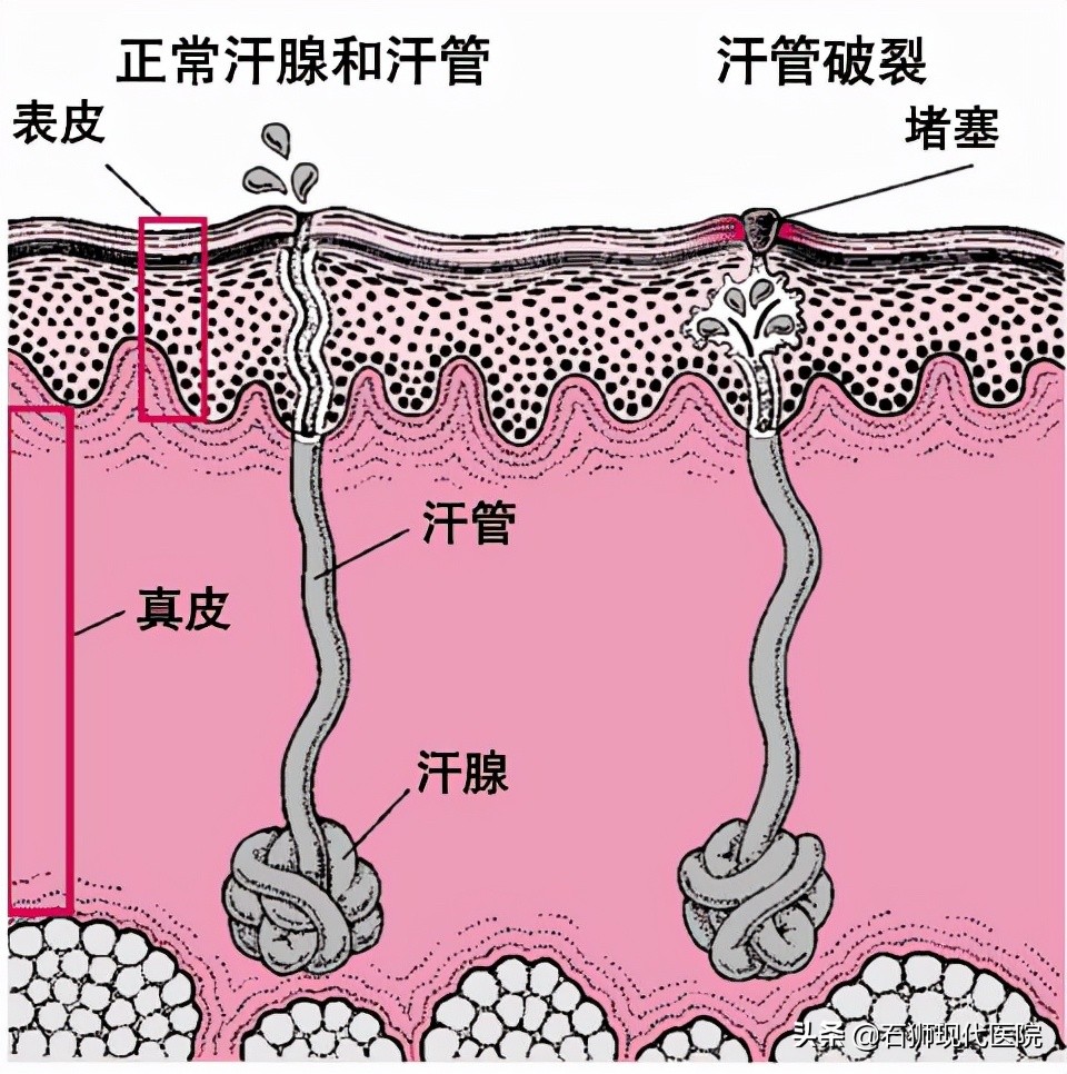 屁股附近总长疮是怎么回事,屁股反复长脓疱疮怎么办