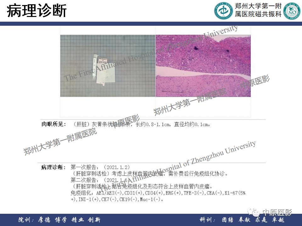 肝脏血管瘤样本,正确认识肝脏血管瘤文章