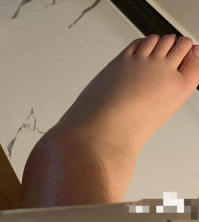 崴脚怎么知道复位了,崴脚别慌4招教你快速康复