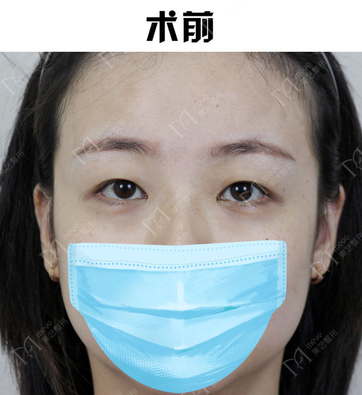 内双贴双眼皮贴可以变外双吗,双眼皮贴内双变外双