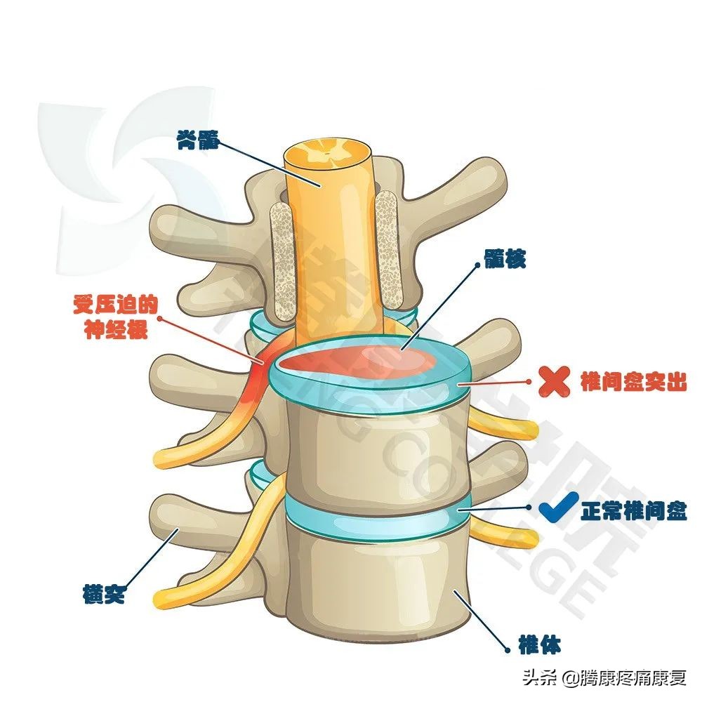 腰5骶1椎间盘突出可以跑步锻炼吗,腰4-5椎间盘突出手术需要多少钱