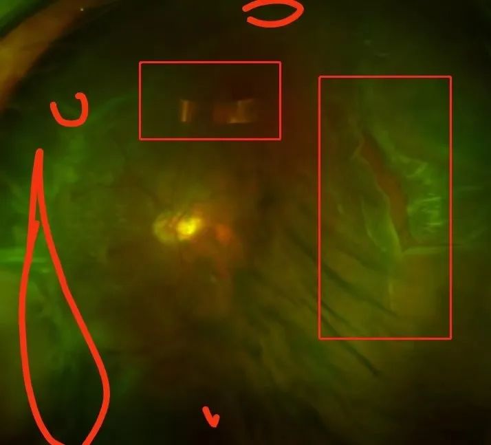 高度近视引起视网膜裂孔多少年了,高度近视造成视网膜破裂的后果