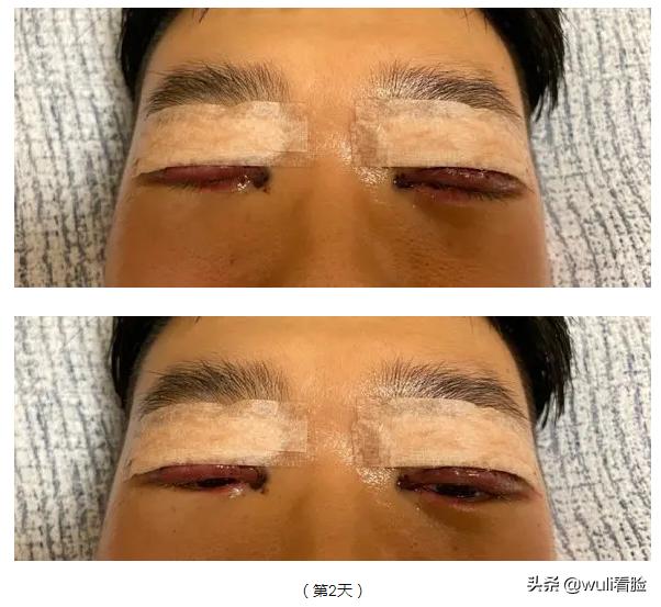 男生割双眼皮的意思,男生眼睛小割双眼皮会好看吗