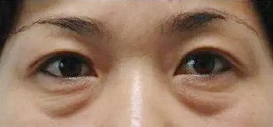 眼袋大怎么办如何解决快又好,眼袋大很显老小妙招