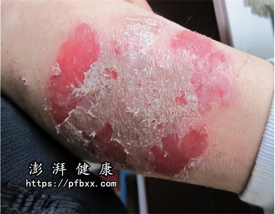 洗完澡后胳膊起皮红斑刺痛,胳膊起红疹不痛不痒怎么回事