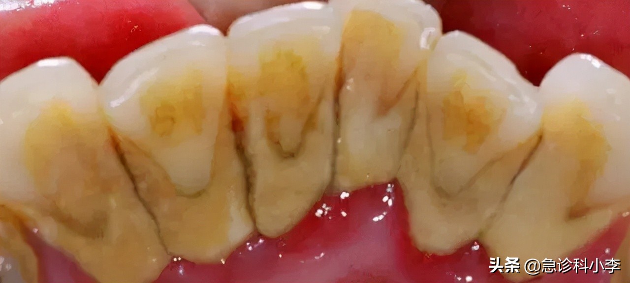 牙缝里的牙结石如何清除干净,在牙缝里的牙结石要怎么去除