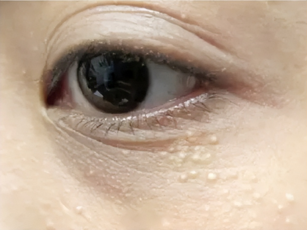 长了脂肪粒觉得眼前模糊正常吗,为什么脂肪粒会越长越多