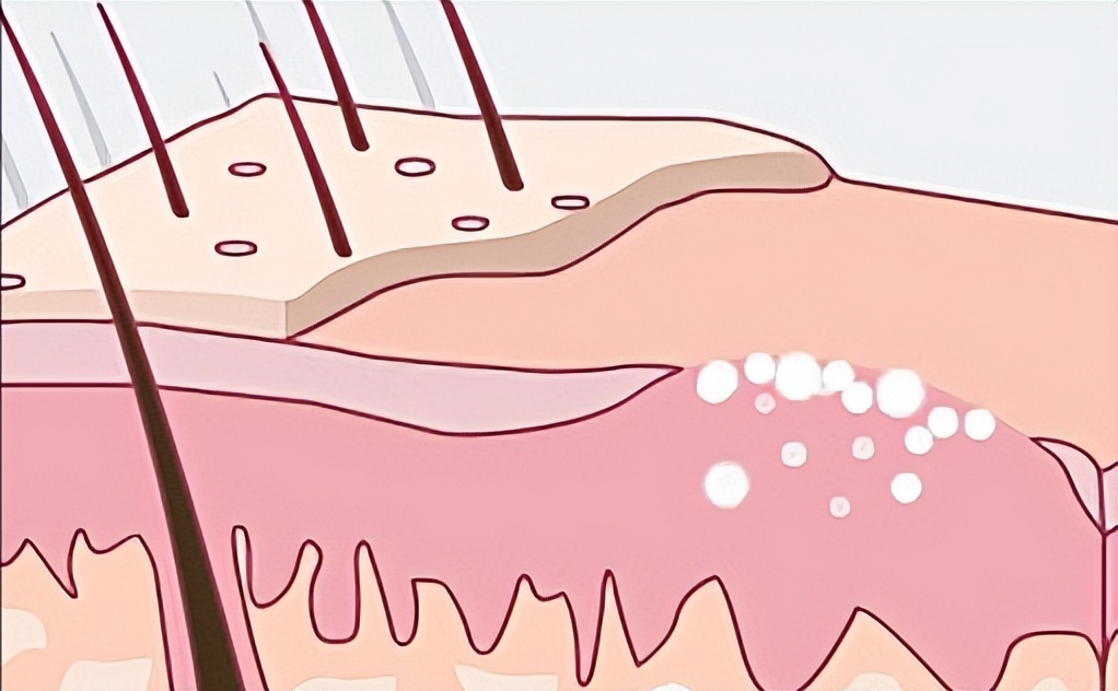 尖锐性湿疣激光术后会留疤吗,尖锐性湿疣做完激光会留疤吗