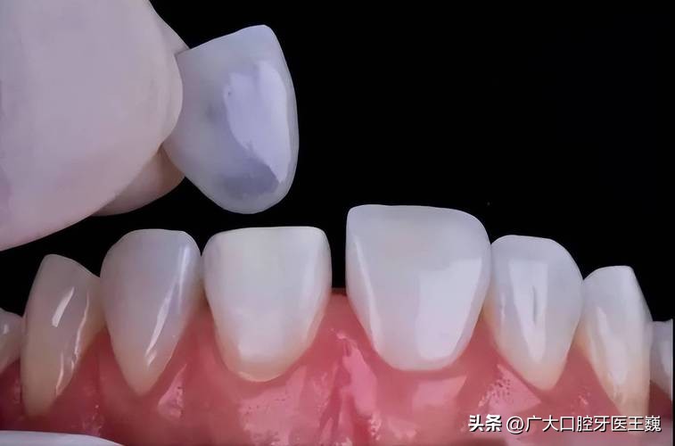 牙齿大门牙磕了一半怎么修复,口腔门牙上颚破了怎么恢复