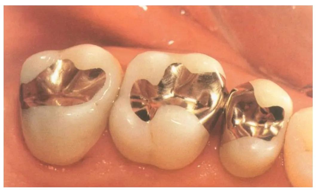 牙齿历险记（第12集）补牙材料