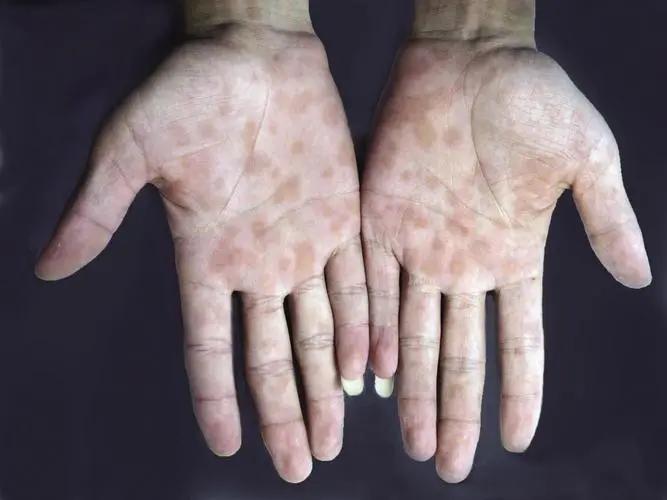 男子腹痛难忍夹出8条活虫,阴虱会寄生人体其他部位吗