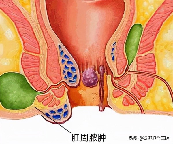 肛肠科十大疼痛之肛周脓肿,肛周脓肿的后遗症