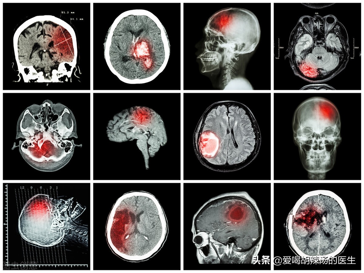 脑梗死手不能动多久恢复,脑梗死左半身偏瘫多久能恢复正常